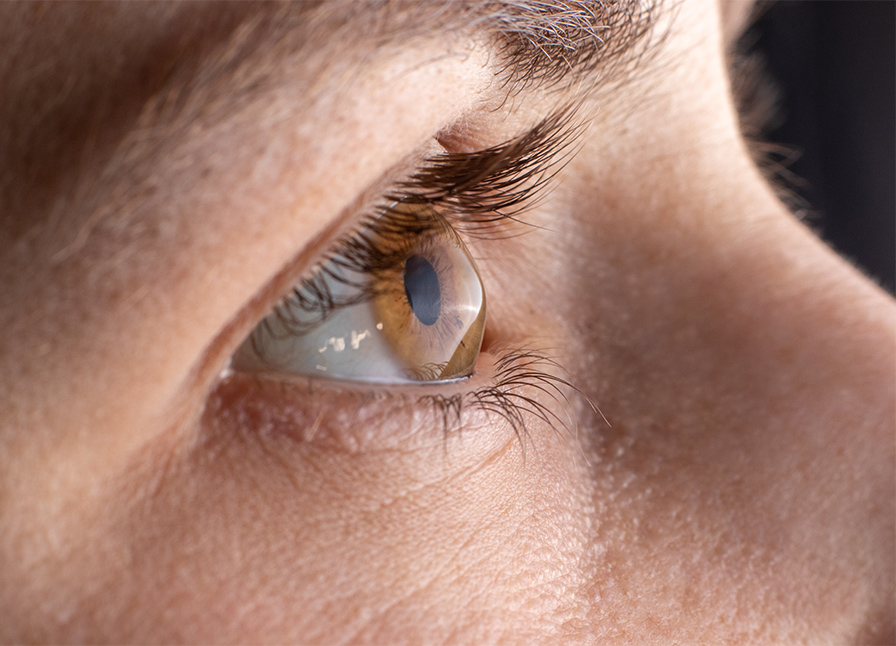Laser eye surgery for keratoconus