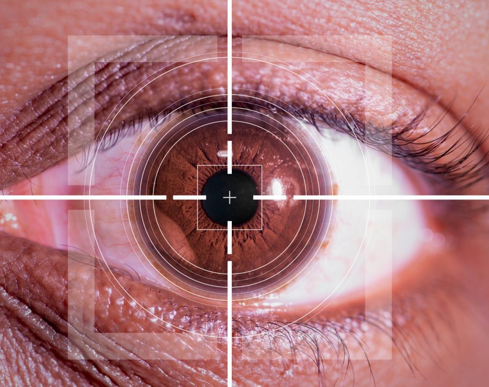 LASIK for astigmatism