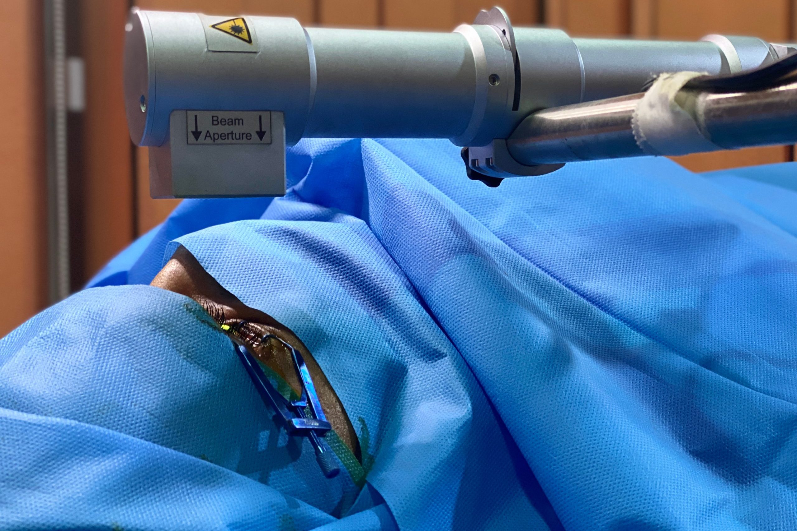 Corneal cross-linking for keratoconus