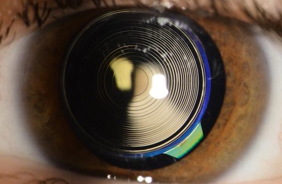 Multifocal lens implant